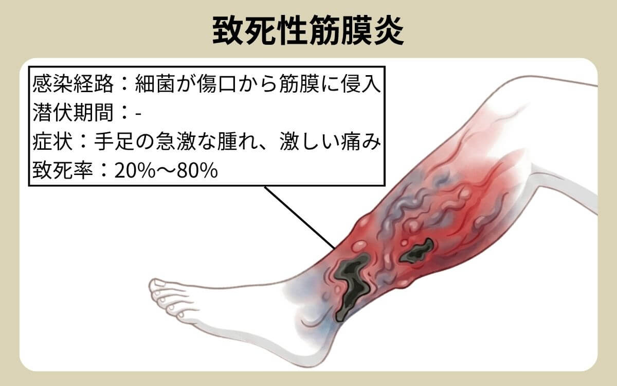 致死性筋膜炎