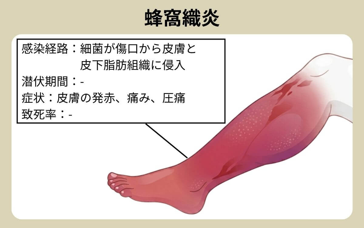 蜂窩織炎